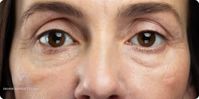 دلایل اصلی آسیب دیدن پوست ناحیه چشم 